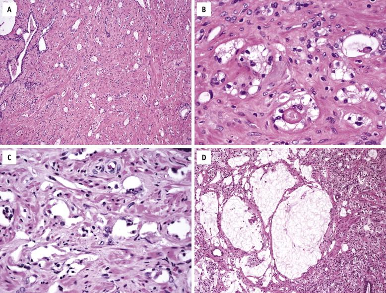 FIGURE 2-20, After hormonal ablation, both benign and malignant glands are markedly atrophic. The cancer glands are smaller, with compressed or obliterated lumina ( A ). Cancer cells have pyknotic nuclei and abundant foamy or clear vacuolated cytoplasm ( B ). They may be dissolved to leave empty clefts ( C ) or mucin aggregates ( D ).