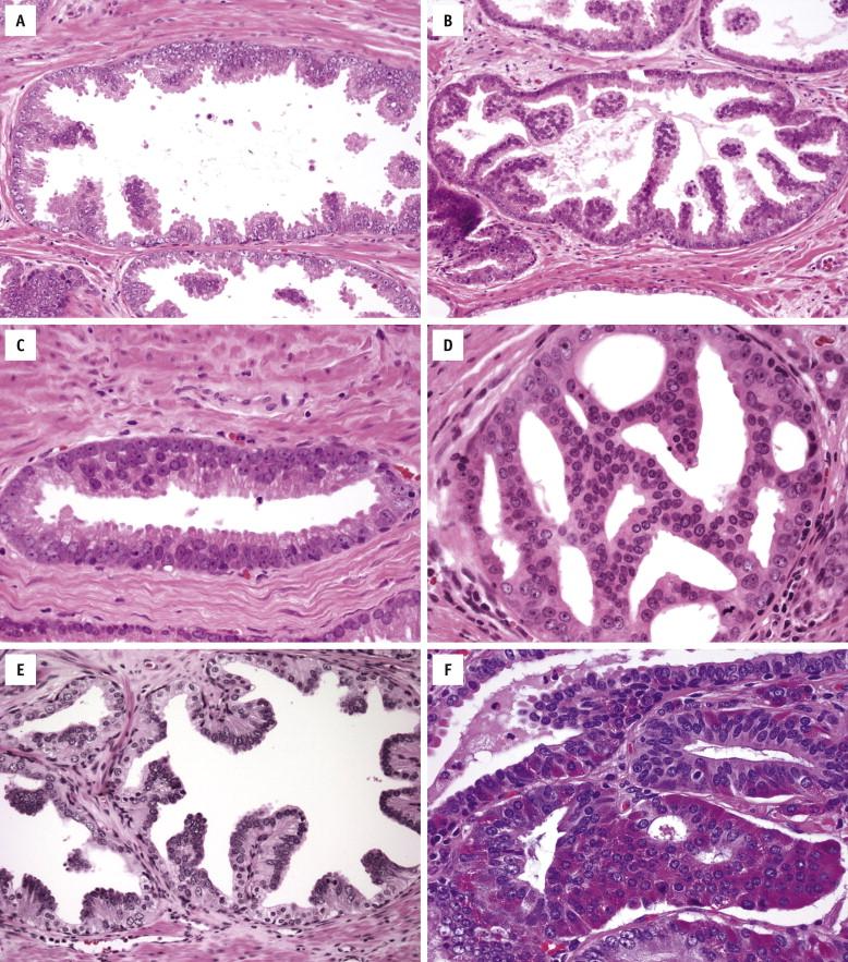FIGURE 2-2, Secretory cells of high-grade prostatic intraepithelial neoplasia (HGPIN) show prominent nucleoli and are hyperchromatic with clumpy chromatin. Cells may form undulating mounds (tufting pattern; A ) or cellular columns without fibrovascular cores (micropapillary pattern; B ). Flat pattern has no significant architectural changes ( C ). Cribriform pattern has complex architecture with epithelial arches and cribriform formations ( D ). Inverted HGPIN is characterized by polarization of enlarged nuclei toward the glandular lumen ( E ). Neuroendocrine HGPIN contains red cytoplasmic granules ( F ).