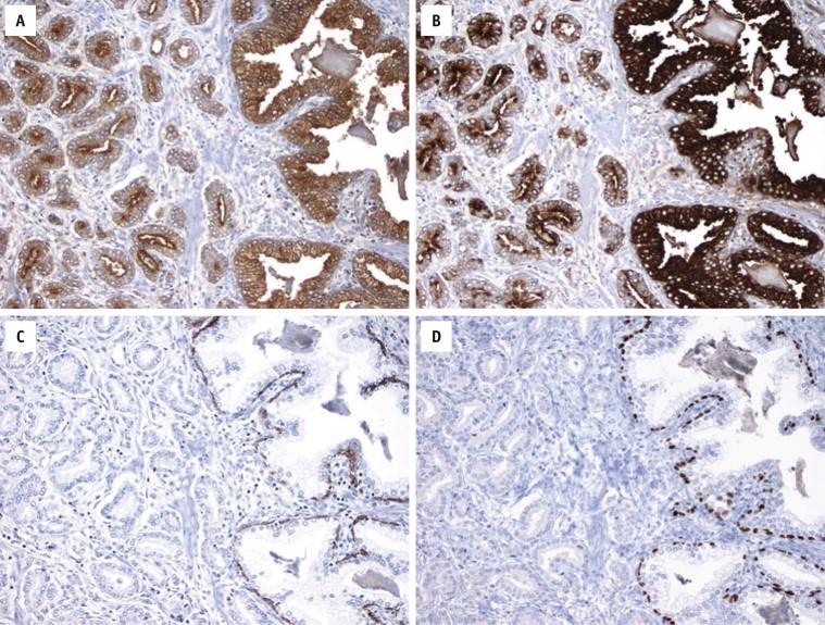 FIGURE 2-22, Benign prostatic glands (right) are positive for prostate-specific antigen (PSA; A ) and prostate-specific acid phosphatase (PSAP; B ). They have a basal cell layer as shown with high–molecular-weight cytokeratin ( C ) and p63 ( D ) immunostains. In contrast, cancer glands (left) are devoid of basal cells, although they are also positive for PSA and PSAP.