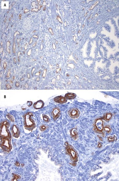 FIGURE 2-23, Cancer glands (left) are positive for α-methylacyl-coenzyme A racemase (AMACR; A ), with apical and cytoplasmic granular staining ( B ). Benign glands (right) are negative for AMACR ( A ).