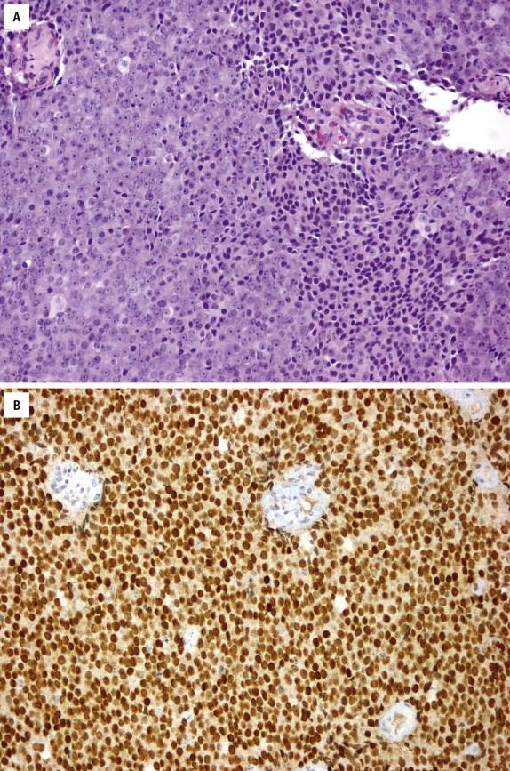 FIGURE 2-25, The differential diagnosis of poorly differentiated prostate cancer ( A ) versus urothelial carcinoma may be challenging. Nuclear staining for NKX3.1 protein ( B ) is highly specific for prostatic adenocarcinoma.