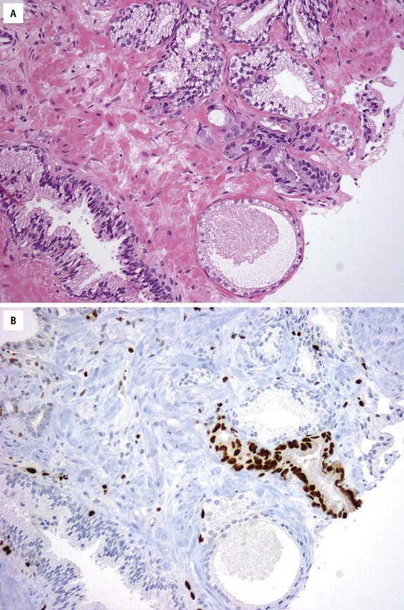 FIGURE 2-27, Prostate needle core biopsy with small focus of atypical glands (right), highly suspicious for prostate cancer ( A ). Given the high specificity for prostate cancer, ERG-positive staining ( B ), in conjunction with architectural and cytological features, helps establish a diagnosis of limited prostate cancer. Endothelial cells and infiltrating stromal lymphocytes represent a useful internal positive control.