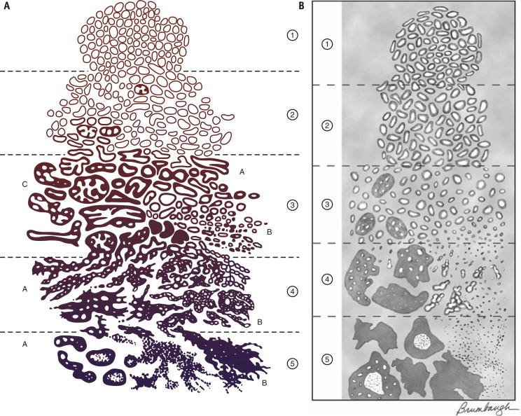 FIGURE 2-28, Gleason grading system for prostate carcinoma. Original standardized drawing for grading prostate carcinoma ( A ) and modified Gleason grading system (2005; B ). In the updated version of the modified Gleason system, cribriform glands are only seen in patterns 4 and 5 ( C ).