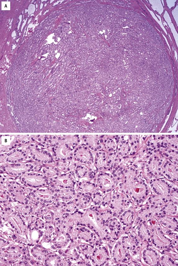 FIGURE 2-29, Gleason pattern 1. Cancer glands, which are closely packed yet separated, of intermediate size, and similar in size and shape, form a circumscribed nodule.