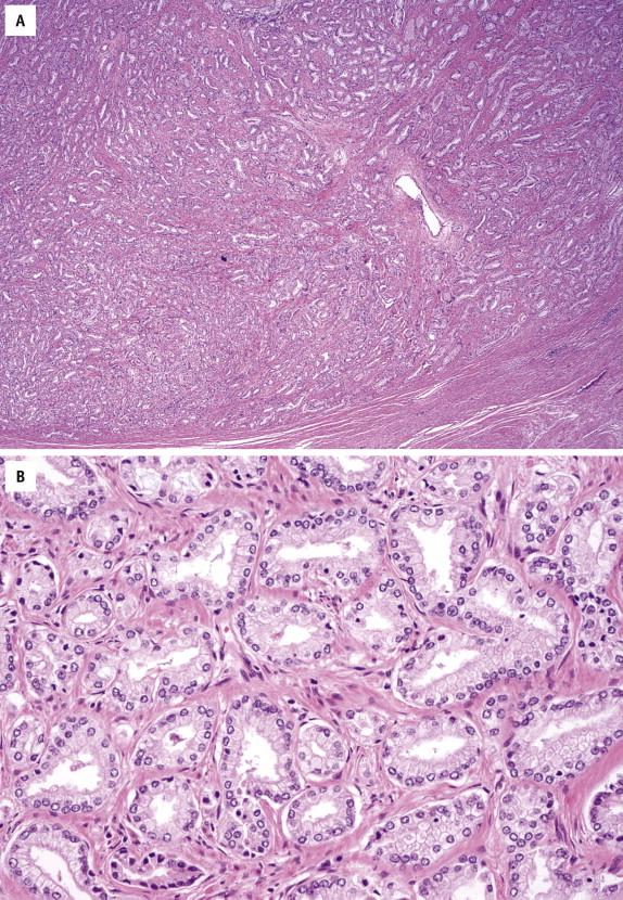 FIGURE 2-30, Gleason pattern 2. Cancer glands are medium-sized, with some degree of variation in size and shape and looser arrangement ( B ). They form a less-well-circumscribed nodule ( A ).