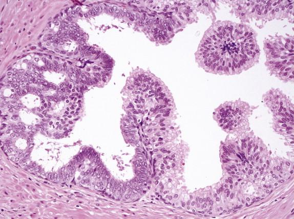 FIGURE 2-3, High-grade prostatic intraepithelial neoplasia showing partial involvement of a prostatic gland.