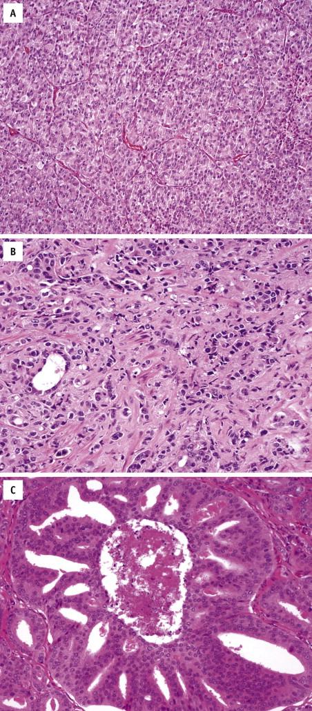 FIGURE 2-33, Gleason pattern 5. Cancer cells forms solid sheets ( A ), strands, or single cells ( B ) that invade the stroma. Comedonecrosis may be present ( C ).