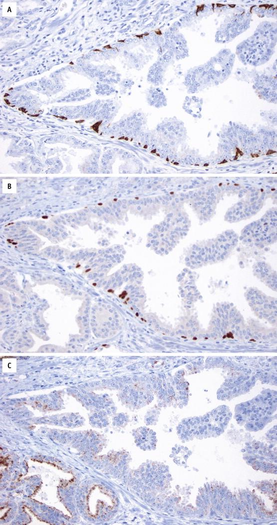 FIGURE 2-4, High-grade prostatic intraepithelial neoplasia (HGPIN) gland has discontinuous basal cell layer, as shown with high–molecular-weight cytokeratin ( A ) and p63 ( B ) immunostains. In contrast, basal cells are absent in cancer glands (left lower corner). HGPIN also has weak expression of α-methylacyl-coenzyme A racemase ( C ), although weaker than the adjacent cancer glands.