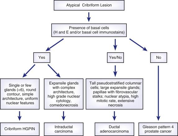 FIGURE 2-5, Differential diagnosis of atypical cribriform lesions on prostate needle biopsies.