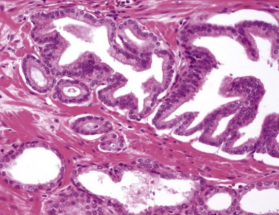 FIGURE 2-6, Adjacent to a high-grade prostatic intraepithelial neoplasia (HGPIN) gland are several small, atypical glands suspicious for cancer. They may represent a minute focus of invasive prostate carcinoma or tangential sectioning of the HGPIN gland.