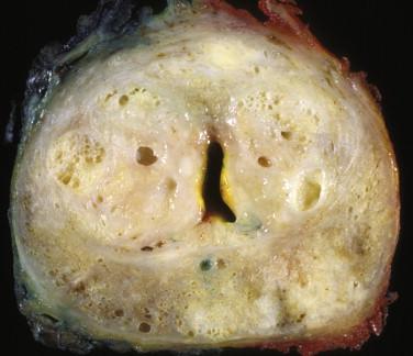 FIGURE 2-7, Prostate carcinoma, manifesting as firm, solid areas ranging from white-gray to yellow-orange with involvement of the left posterolateral and anterior zones. In contrast, benign prostate tissue appears tan and spongy. Also, note that the transition zones are expanded by benign prostatic hyperplasia.