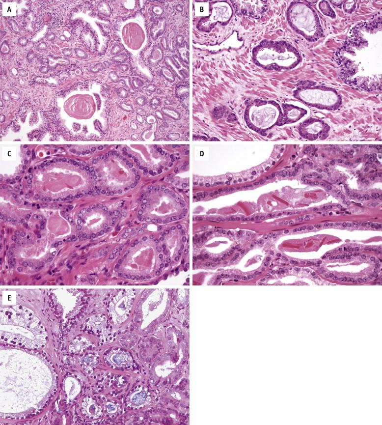 FIGURE 2-8, Prostate carcinoma glands display infiltrative growth pattern, with malignant glands situated between or flanking benign glands ( A ). Cancer cells often have amphophilic cytoplasm ( B ), with enlarged nuclei and prominent nucleoli ( C and D ). Crystalloids are often found in the cancer glandular lumina ( D ), as are intraluminal pink, acellular, dense secretions ( C ) and blue-tinged mucin ( E ). F, Mucinous fibroplasia consists of delicate fibrous tissue with ingrowth of fibroblasts within or adjacent to cancer glands. G, Glomeruloid formation is created by intraluminal proliferation of malignant cells and is often surrounded by a crescentic space. H, In perineural invasion, cancer glands entirely or partially encircle a nerve.