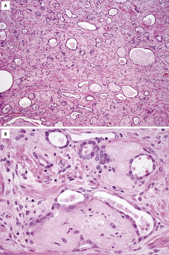 FIGURE 2-9, In atrophic prostate carcinoma, the cancer glands have scant cytoplasm ( A ); however, they display unequivocal malignant histologic features, including prominent nuclei and mucinous fibroplasia ( B ).