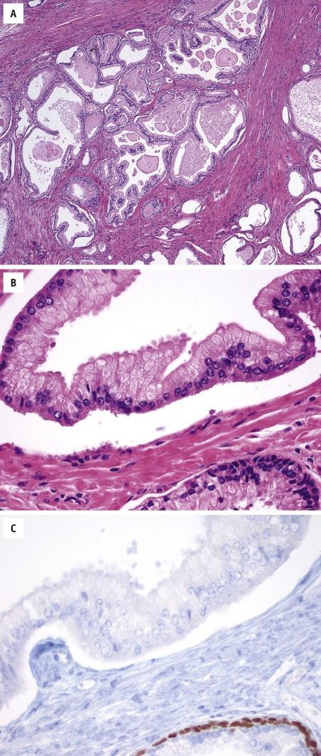 FIGURE 2-10, At low magnification, pseudohyperplastic prostate cancer glands are large with branching and papillary infoldings ( A ), resembling a hyperplastic nodule. However, the cancer glands display prominent nucleoli ( B ) and lack basal cells on p63 immunohistochemistry ( C ).