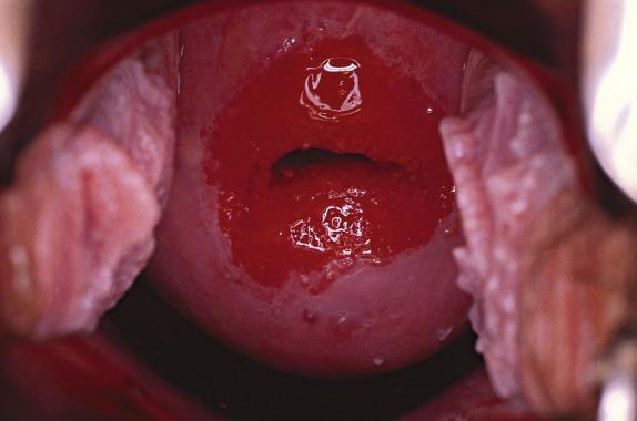 FIG. 8.1, Ectropion. By colposcopy, the endocervical mucosa has a rough, red appearance, in sharp contrast to the smooth pink surface of the native squamous epithelium.