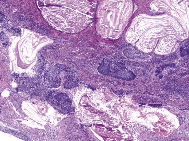 FIG. 8.12, Pseudoinvasion. Distorted fragments of highly dysplastic squamous epithelium are present within the cervical stroma but are not associated with desmoplasia.