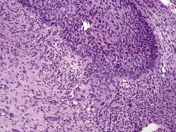 FIG. 8.13, Early invasive squamous cell carcinoma. Paradoxical maturation associated with marked inflammation and stromal reaction are seen.