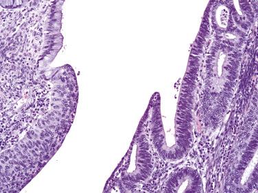 FIG. 8.14, Adenocarcinoma in situ (AIS). A segment of normal glandular epithelium adjacent to high-grade squamous intraepithelial lesion (left) and AIS (right) where nuclear hyperchromasia and crowding can be appreciated.