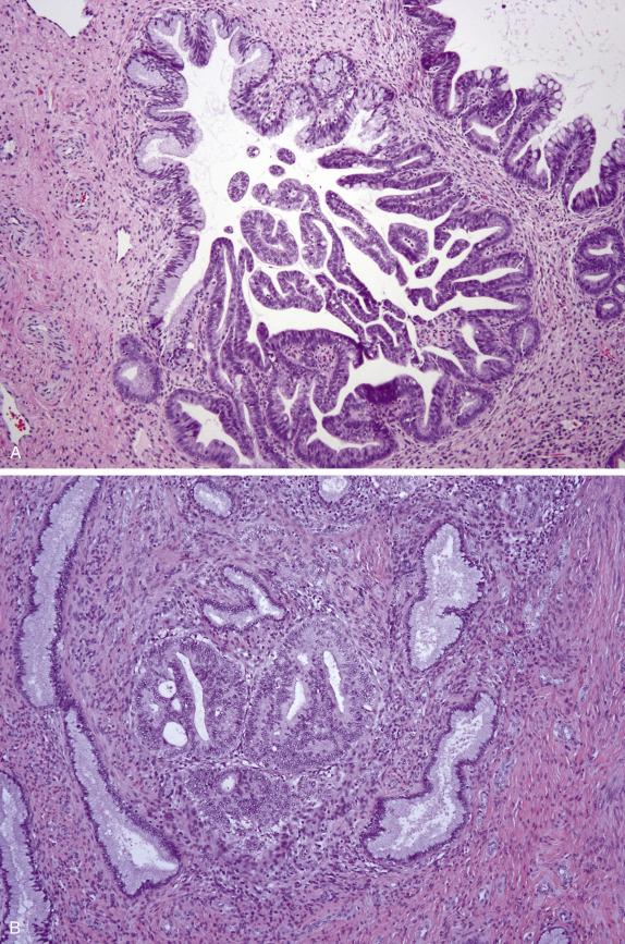 FIG. 8.15, Adenocarcinoma in situ (AIS). Intraglandular papillary projections and abrupt transition to normal endocervical epithelium (A). Intraglandular cribriforming of neoplastic cells in native endocervical glands without stromal reaction (B). Note numerous mitotic figures and apoptotic bodies (C). AIS with mucin-rich (including goblet cells) and mucin-poor cells (D).