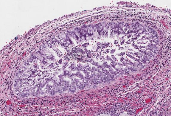 FIG. 8.17, Gastric-type adenocarcinoma in situ. A superficial gland is involved by an abnormal mucinous proliferation displaying significant nuclear enlargement and stratification. The apical pale mucinous cytoplasm is discernible. This lesion was negative for p16, hormone receptors and human papillomavirus molecular testing.