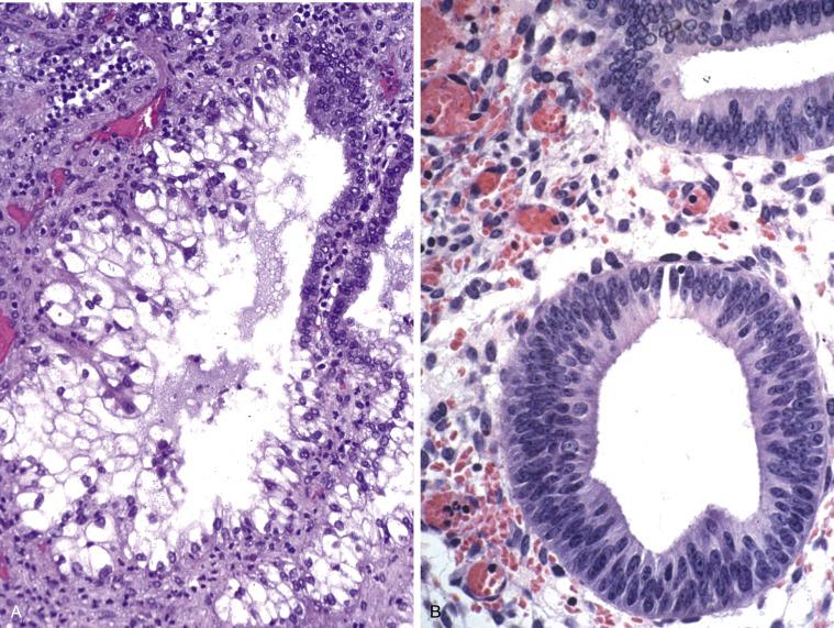 FIG. 8.19, Non-neoplastic mimics of adenocarcinoma in situ (AIS). Arias Stella-Reaction. There is nuclear enlargement and hyperchromasia of part of the lining epithelium. In contrast to AIS, the cells have abundant clear cytoplasm, smudgy chromatin, and no mitotic figures (A). Cervical endometriosis. There is nuclear crowding and hyperchromasia of the epithelial cells. Notice the accompanying edematous and focally hemorrhagic endometrial stroma and small vessels surrounding the endometrial-type gland (B). Tubal metaplasia. There is preservation of the nuclear-to-cytoplasmic ratio, absence of mitoses and apoptotic bodies, and presence of intercalated cells and cilia (C).