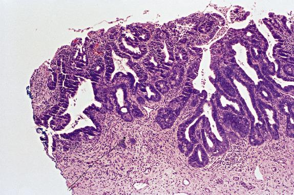 FIG. 8.20, Adenocarcinoma in situ. Involvement of the inked endocervical margin in a cone excision.