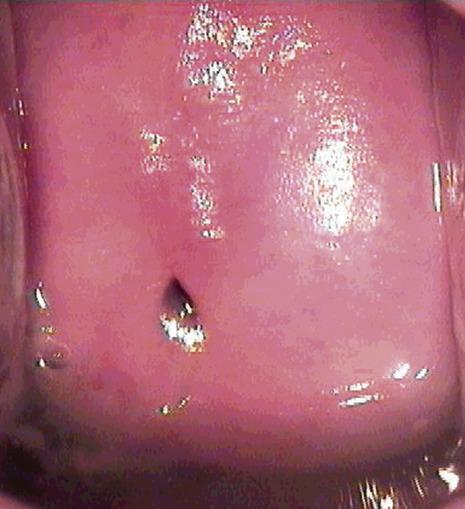 FIG. 8.2, Indeterminate colposcopy. The transformation zone has receded into the endocervical canal in a postmenopausal woman.