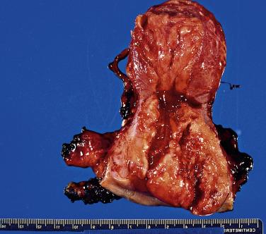 FIG. 8.23, Squamous cell carcinoma. A large fungating mass is centered in the transformation zone and grows into the endocervical canal.