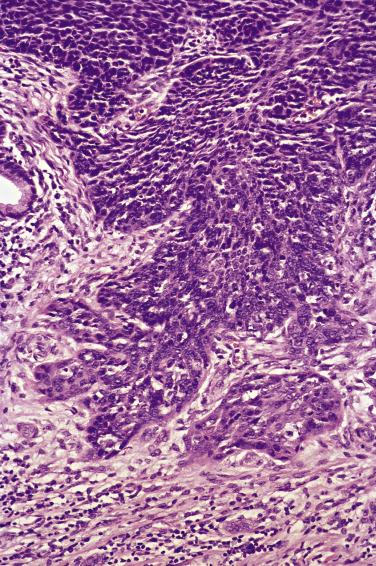 FIG. 8.24, Early invasive squamous cell carcinoma. Irregularly shaped nest of malignant squamous epithelium can be appreciated along the inferior aspect of a gland involved by a high grade squamous intraepithelial lesion.