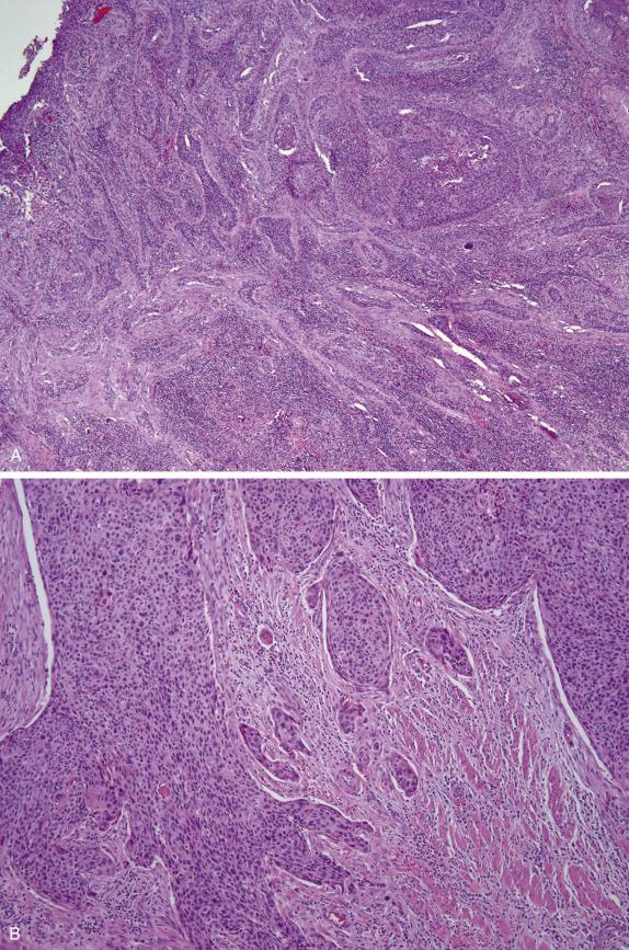 FIG. 8.25, Moderately differentiated squamous cell carcinoma. The tumor is deeply invasive and is composed of irregular, angulated, or spiked islands of tumor cells associated with a prominent desmoplastic reaction (A). The tumor cells have abundant eosinophilic cytoplasm with individual keratinization and prominent nuclear pleomorphism (B). The desmoplastic stroma is heavily infiltrated by inflammatory cells, with eosinophils or lymphocytes predominating (C).