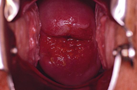 FIG. 8.3, Low-grade squamous intraepithelial lesion. Colposcopic exam shows acetowhite epithelium involving the anterior lip.