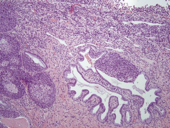 FIG. 8.7, High-grade squamous intraepithelial lesion. Partial involvement of endocervical glands.