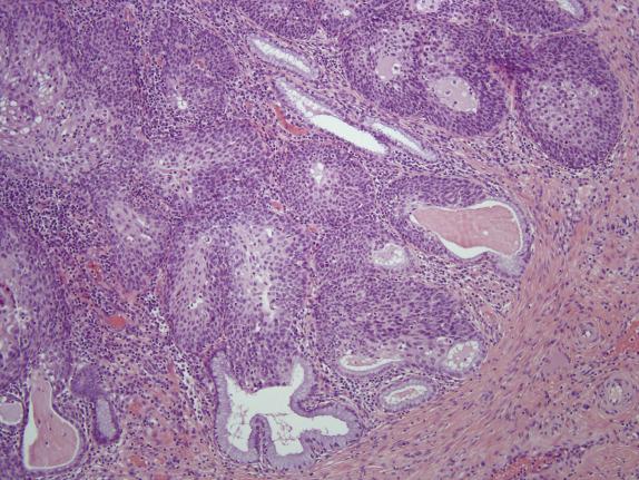 FIG. 8.8, High-grade squamous intraepithelial lesion with prominent endocervical gland involvement. There is a smooth rounded contour of the gland with an intact basement membrane, and no associated desmoplasia.