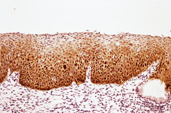 FIG. 8.9, High-grade squamous intraepithelial lesion. Strong and diffuse nuclear and cytoplasmic p16 staining of the lower two-thirds of the epithelium.