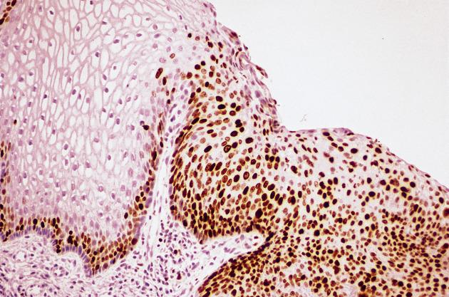 FIG. 8.10, High-grade squamous intraepithelial lesion. MIB-1 immunoreactivity is present in nuclei at all levels of the lesion (right aspect), whereas in normal epithelium (left aspect) it is limited to the parabasal layer.