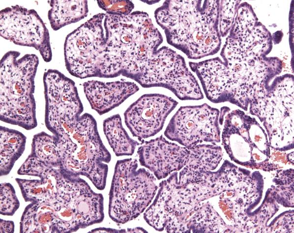 FIG. 6.1, Müllerian papilloma. Papillary fronds are lined by bland cuboidal epithelium.