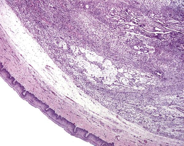 FIG. 6.2, Mixed tumor of the vagina (spindle cell epithelioma). A well-circumscribed tumor shows stromal-like and epithelial components (upper right) .