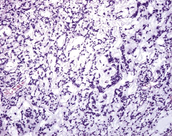 FIG. 6.3, Mixed tumor of the vagina (spindle cell epithelioma). A reticular pattern of the stromal-like cells is associated with a myxoid background.