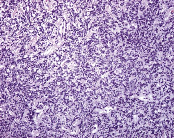 FIG. 6.4, Mixed tumor of the vagina (spindle cell epithelioma). The stromal-like cells form irregular anastomosing cords.