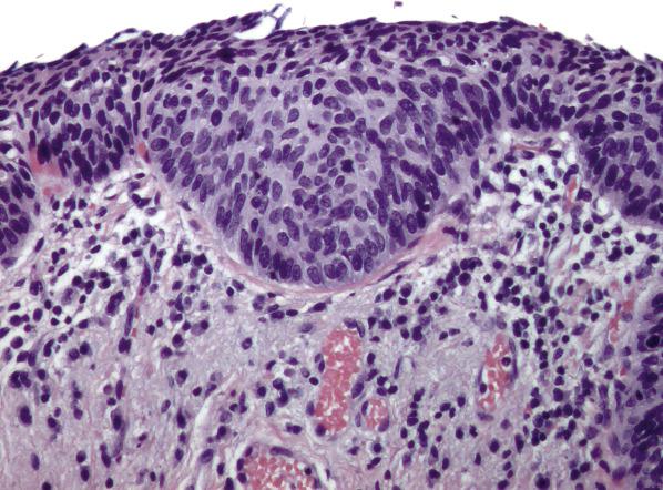 FIG. 6.8, High-grade squamous intraepithelial lesion (vaginal intraepithelial neoplasia – VAIN III). Severe cytologic atypia, mitotic activity, and loss of maturation are seen throughout the full thickness of the epithelium.