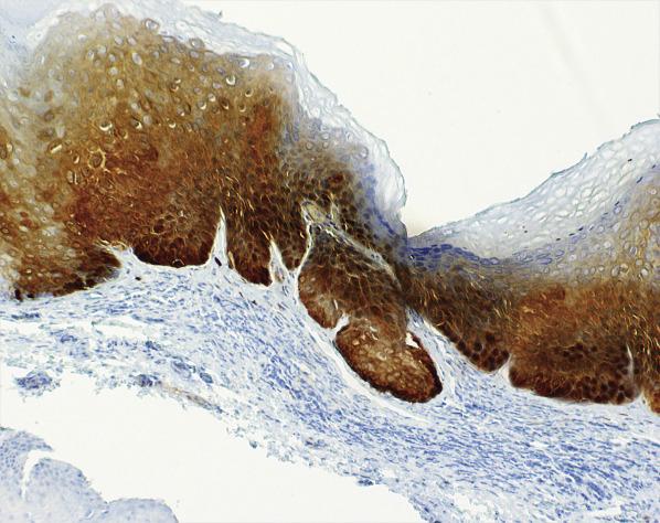 FIG. 6.9, High-grade squamous intraepithelial lesion. Strong and diffuse block positive p16.