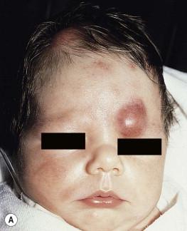 Figure 28.1, (A) The large nodule above the eye of this neonate represented a manifestation of congenital leukemia resulting from acute lymphocytic leukemia. (B) Congenital acute myelogenous leukemia with purpuric nodules and areas of macular purpura.