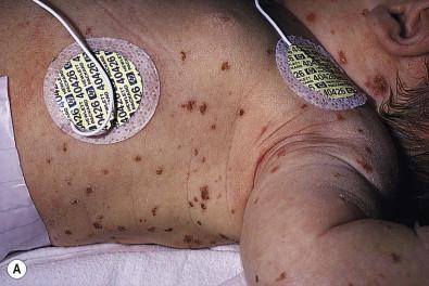 Figure 28.3, Multiple crusted papules are typical of the ‘self-healing’ variant of congenital Langerhans' cell histiocytosis.