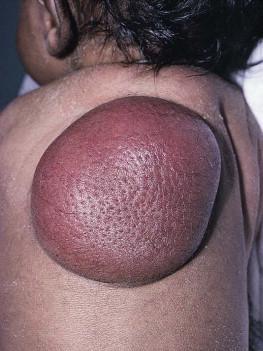 Figure 28.7, Giant cell fibroblastoma, considered by some to be a variant of dermatofibrosarcoma protuberans.