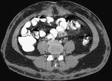 Figure 83-1, Postsurgical diffuse fat stranding. Axial contrast-enhanced computed tomography image of the abdomen shows diffuse subcutaneous fat stranding in a 32-year-old woman 2 days after abdominoplasty. Note diffuse thickening of the subcutaneous tissue, with no fluid collections.