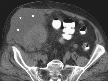 Figure 83-2, Abdominal wall seroma. Axial unenhanced computed tomography image of the abdomen shows an abdominal wall fluid collection (seroma, asterisks ), located superficial to a renal transplant in the right iliac fossa.