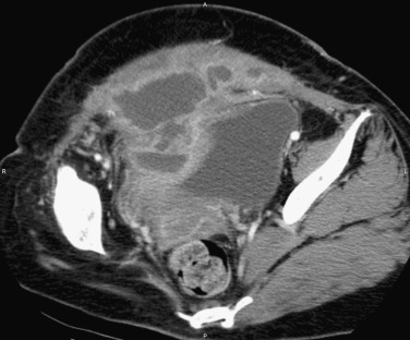 Figure 83-3, Abdominal wall abscess. Axial contrast-enhanced computed tomography image of the abdomen shows a complex pelvic collection extending into the abdominal wall in a 41-year-old woman that was secondary to pelvic inflammatory disease.