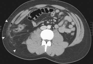 Figure 83-5, Abdominal wall rupture. Axial contrast-enhanced computed tomography image demonstrating traumatic rupture of the right posterolateral abdominal wall (arrowheads) in a 23-year-old man after blunt trauma to the abdomen. Note discontinuity of the abdominal wall in this region.