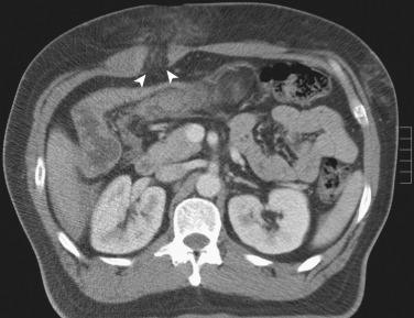 Figure 83-6, Ruptured rectus abdominis muscle. Axial contrast-enhanced computed tomography image in a 36-year-old man showing rupture of the right rectus abdominis muscle (arrowheads) after blunt abdominal trauma, with herniation of extraperitoneal fat into the subcutaneous tissue.