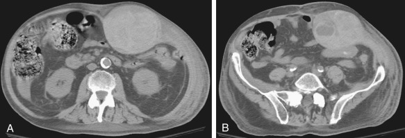 Figure 83-7, Abdominal wall hematoma. Axial unenhanced computed tomography images of the abdomen through the (A) lower pole of the kidneys and (B) level of the umbilicus in a 62-year-old anticoagulated patient that show a left rectus abdominis muscle hematoma. Note heterogeneous density of the hematoma with multiple fluid-fluid levels and moderate stranding in the subcutaneous fat.